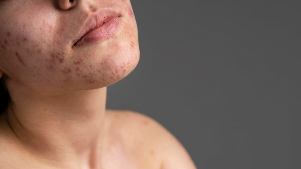 close-up-portrait-young-woman-with-acne