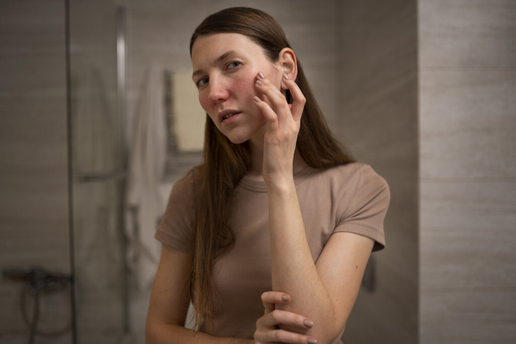 Woman Dealing With Rosacea Skin Condition Face